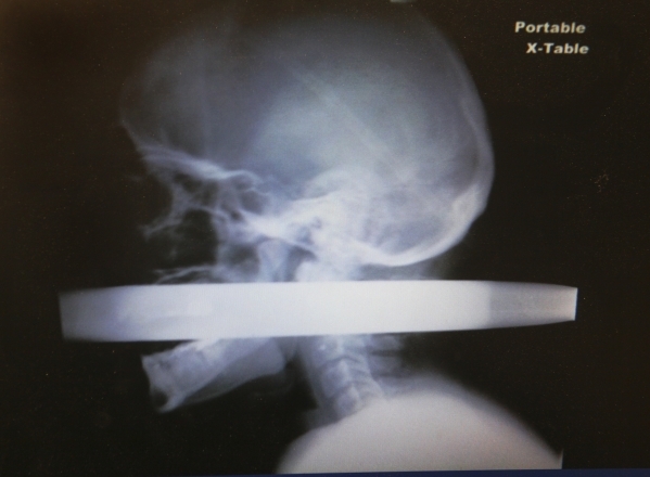An X-ray shows a piece of pipe driven through the mouth and out the back of the neck of crash victim Andrew Linn. He recovered from the Nov. 29, 2010, crash under the care of a UMC trauma team hea ...